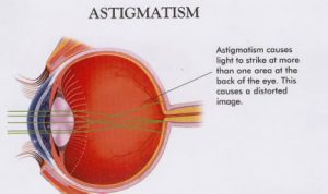 astigmatism-300x178