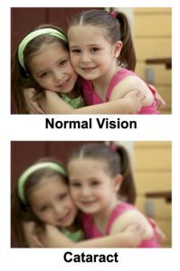 cataract-1