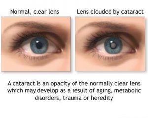 cataract-picture-c