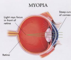 myopia